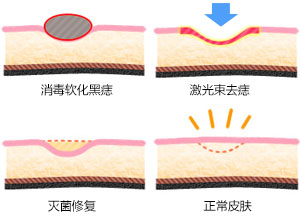 激光点痣原理